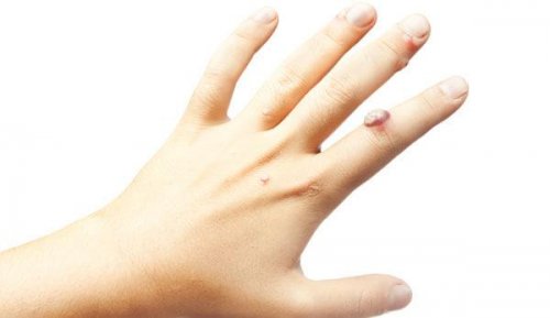 Nagellack innovativ nutzen bei Warzen