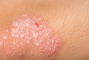 Ekzem: Hilfe aus der Apotheke der Natur