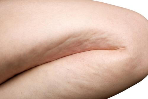 bestimmte Nahrungsmittel fördern Cellulite