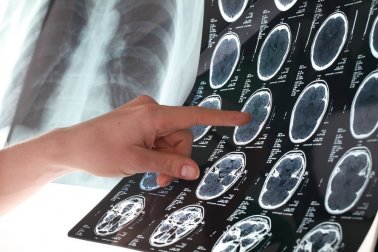Wie erkennt man einen Schlaganfall und: was dann?
