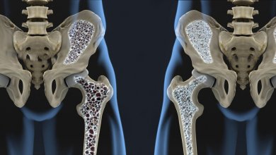 So kannst du Osteoporose langfristig vorbeugen!