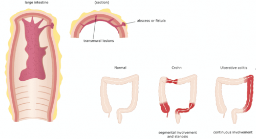 Crohn-Krankheit und Darmentzündung