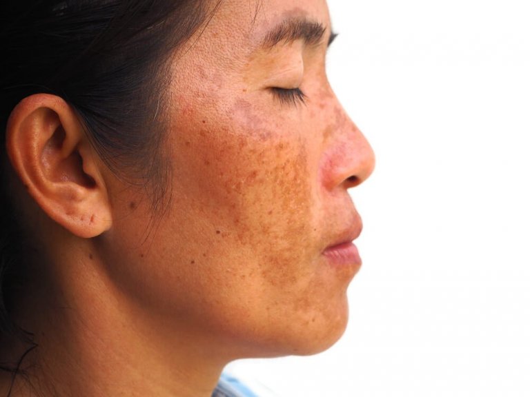 Hyperpigmentierung mit natürlicher Gesichtsmaske mildern
