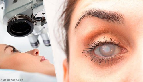 Katarakt: Symptome und gesundheitsfördernde Maßnahmen