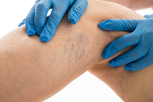 8 Methoden zur Behandlung von Krampfadern