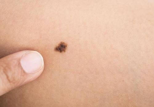 7 Anzeichen, dass dein Baby zum Arzt muss: Leberfleck