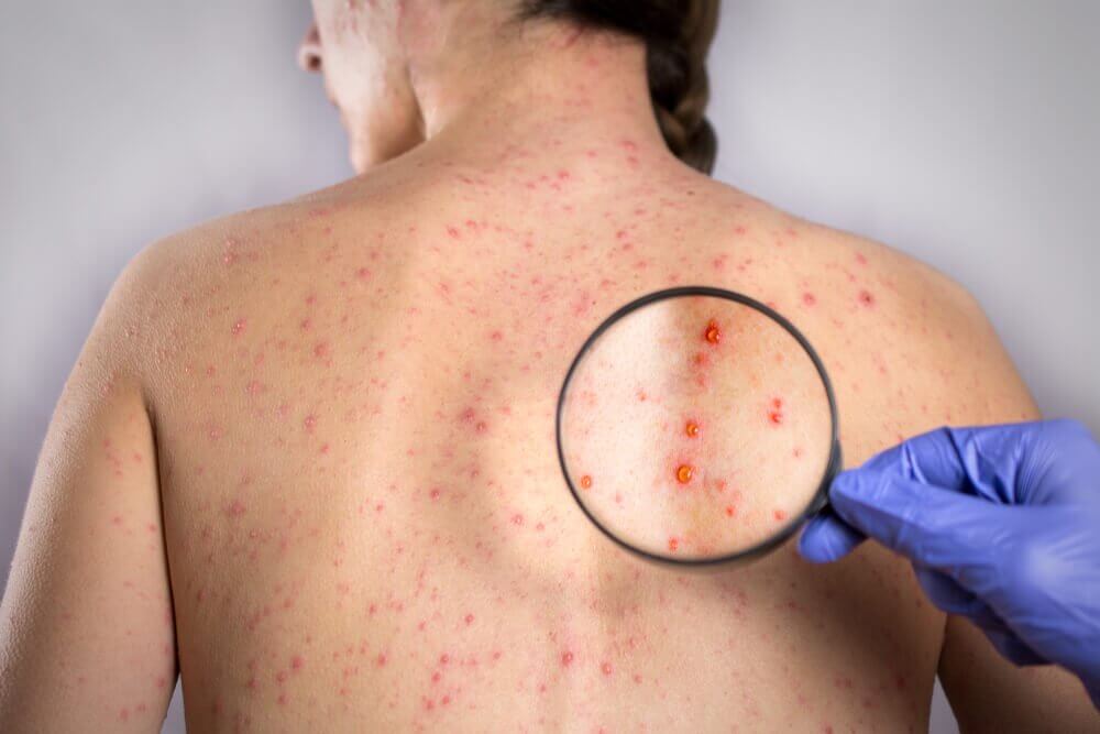 Fünf Naturheilmittel gegen Herpes am Rücken