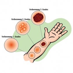 Verbrennungen behandeln mit Natron