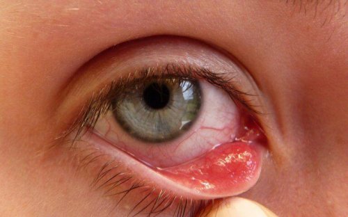 Gerstenkorn am Auge ist schmerzhaft