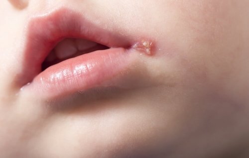 Lippenherpes ist eine der möglichen Formen von Herpes bei Kindern.