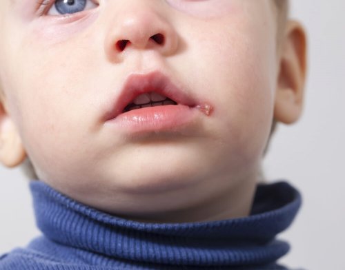Symptome und Behandlung von Herpes bei Kindern