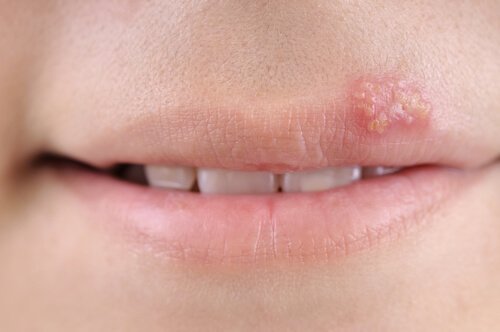 Herpes bei Kindern, erfahre mehr über die verschiedenen Typen des Virus.