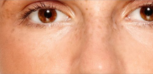 Wie vermindert man Hautflecken, die durch Hyperpigmentierung entstanden sind?