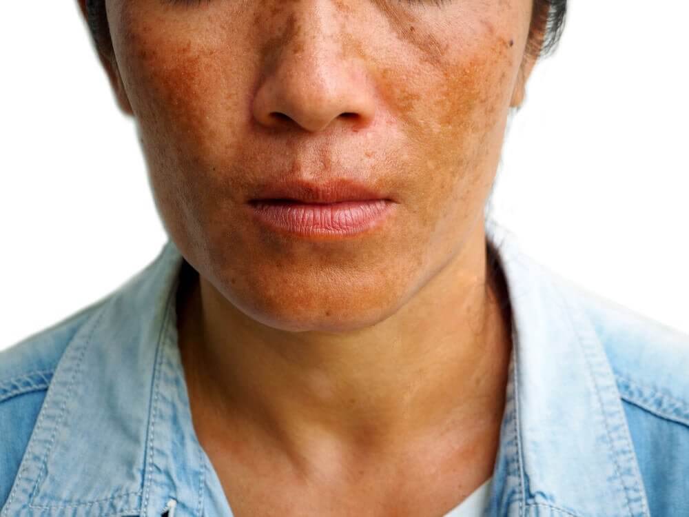 Hautflecken durch Hyperpigmentierung reduzieren: 3 Behandlungsmethoden