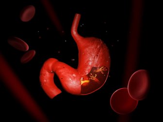Naturheilmittel gegen Helicobacter pylori-Infektion