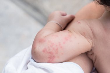 Hitzeausschlag bei Babys