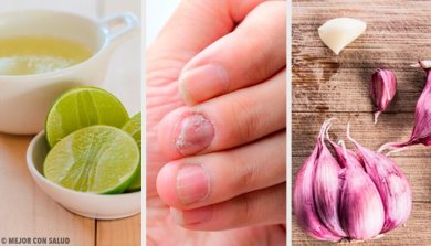 Nagelpilz behandeln mit diesen Hausmitteln
