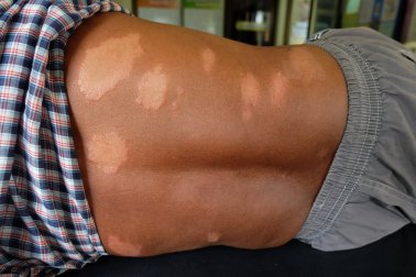 Lepra: Natürliche Mittel zur Linderung der Symptome