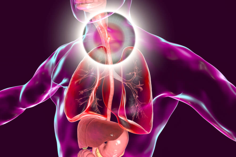 Entzündung der Speiseröhre: was tun? - Besser Gesund Leben