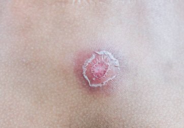 7 Tipps, mit denen man Furunkel bekämpfen kann