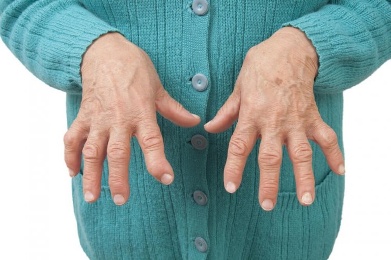 Naturheilmittel, mit denen man rheumatoide Arthritis lindern kann