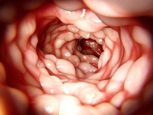 Aufnahme von innen, die einen geschwollenen Darm zeigt.