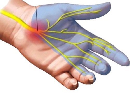 Schmerz strahlt in die Finger aus