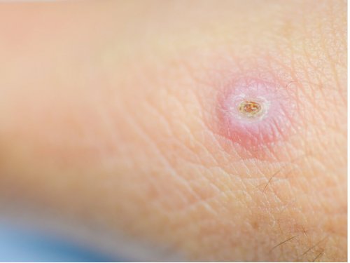 Furunkel bekämpfen: 7 Tipps - Besser Gesund Leben