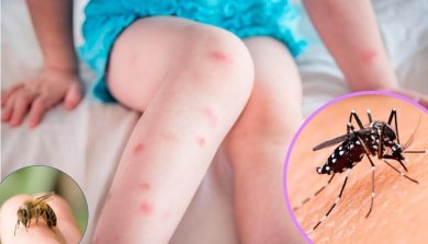 Die 5 häufigsten Insektenstiche erkennen und behandeln