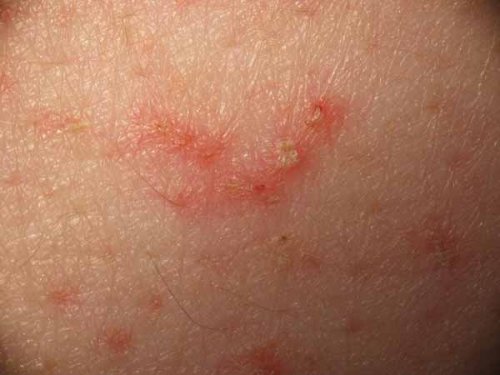 Eigenschaften von Aloe vera gegen Allergien