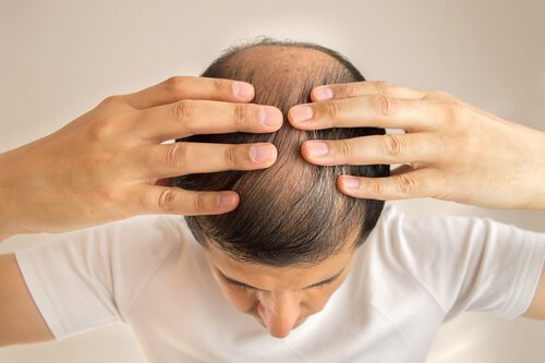 Haarausfall mit Honig behandeln
