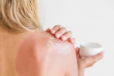 Bodylotion oder After Sun Lotion: was ist besser bei Sonnenbrand?
