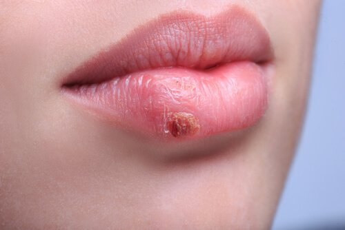 Herpes an der Lippe