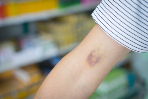 Bluterguss am Arm