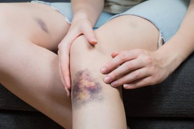 Bluterguss: 5 natürliche Tipps zur Linderung