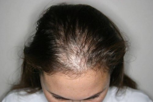 Eine Frau mit Alopecia.