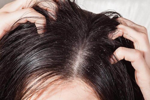 Gründe für deinen Haarausfall können auch Infektionen oder hier abgebildete Schuppen.