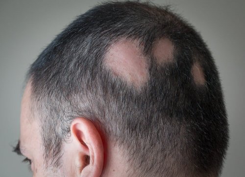 Männlicher Kopf mit kahlen Stellen