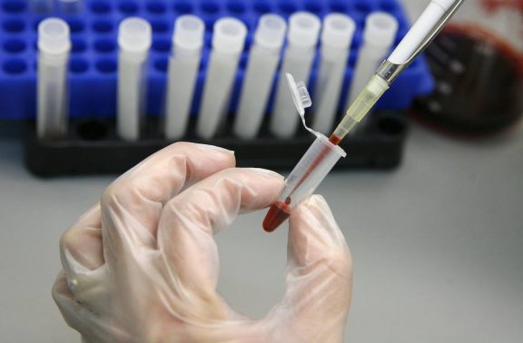 Stammzelltransplantation könnte HIV-Virus ausmerzen