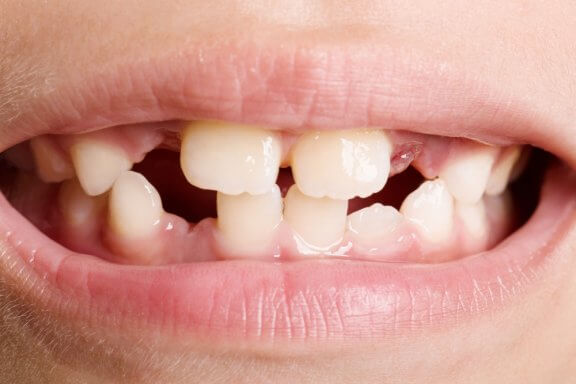 Zahnagenesie: Arten und Behandlungsformen