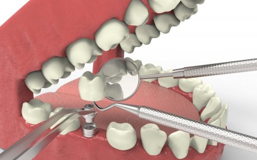 Abbildung eines Zahnimplantats