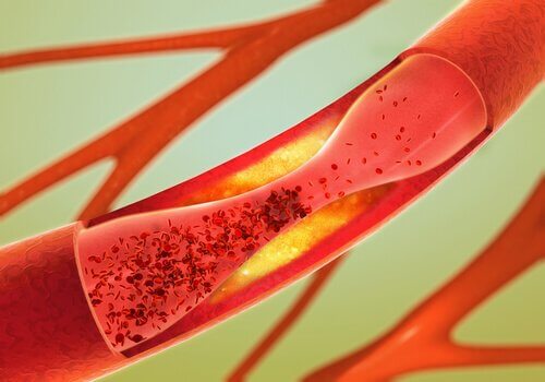 Kann man durch Arteriosklerose „verkalkte“ Arterien wieder „entkalken“?