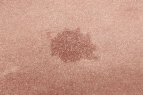 Dunkle Hautflecken entstehen durch einen höheren Melaningehalt an diesen Hautstellen