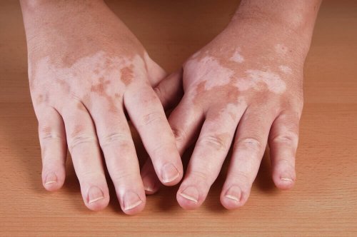 Vitiligo kann weiße Flecken auf der Haut auslösen