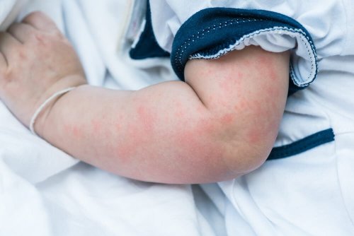 Hautausschlag bei Babys: Was tun?