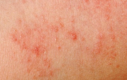 Akne kann ein Auslöser von roten Hautflecken sein
