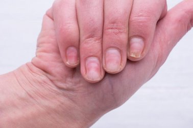 Das hilft gegen gelbe Fingernägel