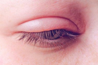 Blepharitis: Ursachen und Behandlung