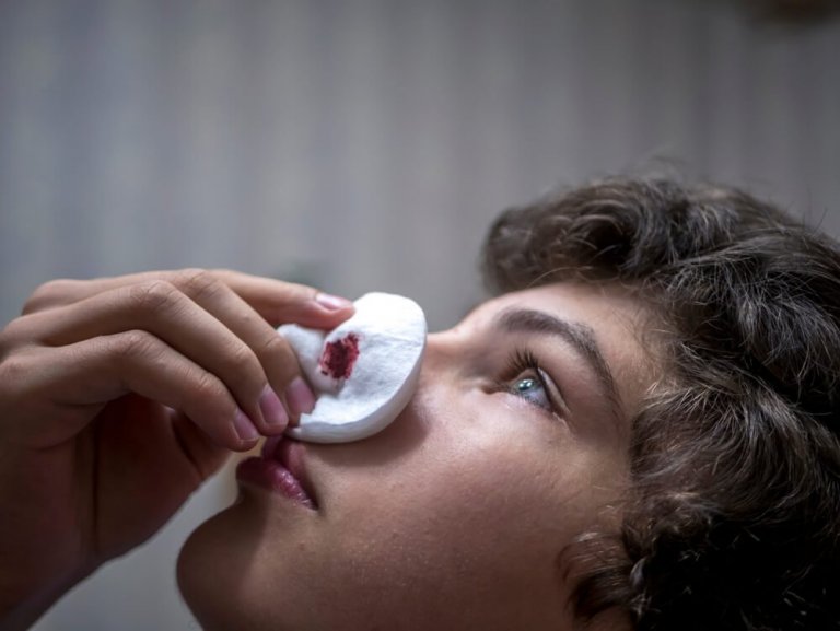 7 Tipps gegen Nasenbluten