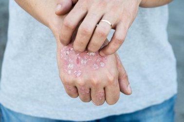 5 äußerlich anwendbare Naturheilmittel gegen Schuppenflechte